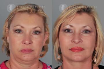 Facelift and Necklift Before and after photos in Sandy Springs, GA, Patient 15873