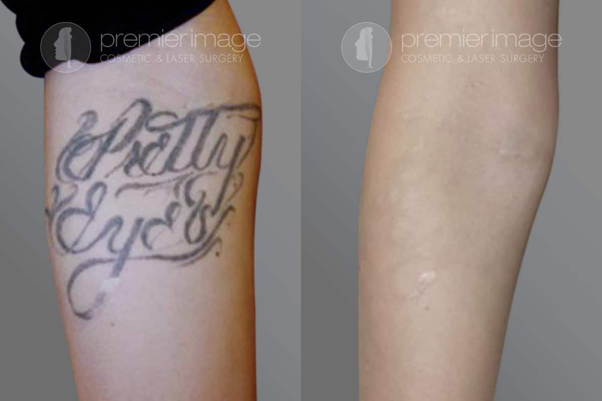 Laser Tattoo Removal Atlanta, GA