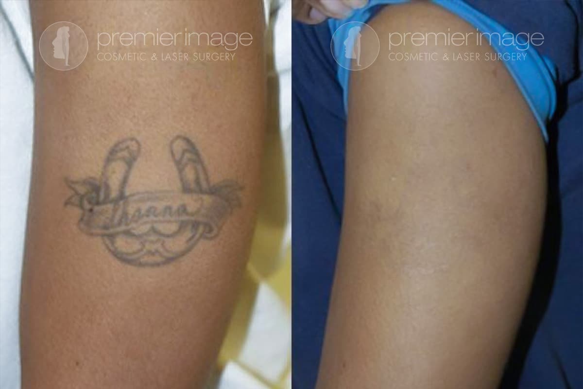 Laser Tattoo Removal Atlanta, GA