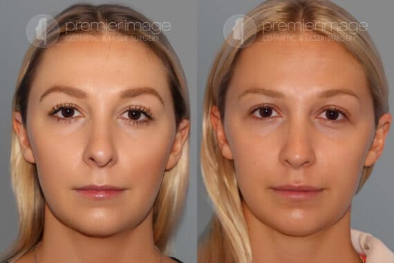Revision Rhinoplasty Before and after photos in Sandy Springs, GA, Patient 28150