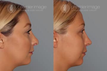 Revision Rhinoplasty Before and after photos in Sandy Springs, GA, Patient 28150