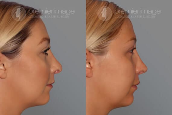 Revision Rhinoplasty Before and after photos in Sandy Springs, GA, Patient 28150