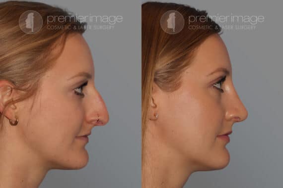 Open Rhinoplasty Before and after photos in Sandy Springs, GA, Patient 28169