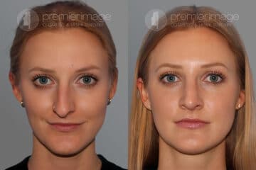 Open Rhinoplasty Before and after photos in Sandy Springs, GA, Patient 28169