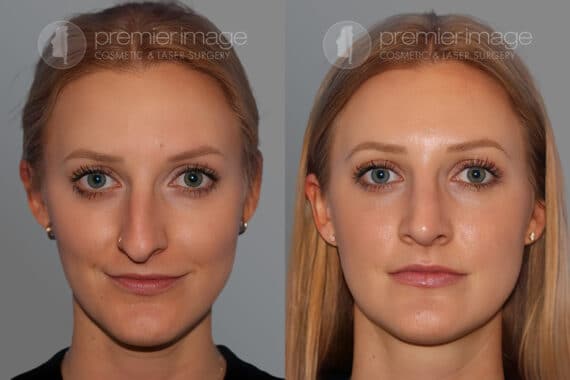 Open Rhinoplasty Before and after photos in Sandy Springs, GA, Patient 28169