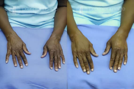 Radiesse Injection Hand Rejuvenation Before and after photos in Sandy Springs, GA, Patient 16253