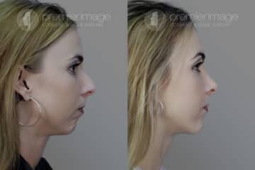 Rinoplastia Fotos Antes y Después en Sandy Springs, GA, Patient 19985