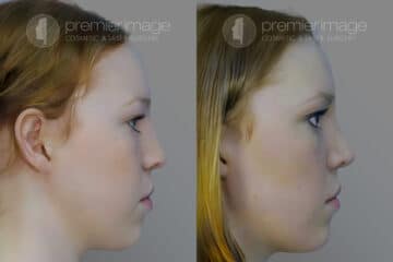  Rinoplastia Fotos Antes y Después en Sandy Springs, GA, Patient 19983