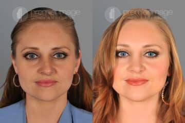  Rinoplastia Fotos Antes y Después en Sandy Springs, GA, Patient 19974