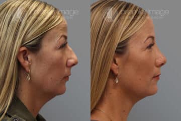  Rinoplastia Fotos Antes y Después en Sandy Springs, GA, Patient 19762