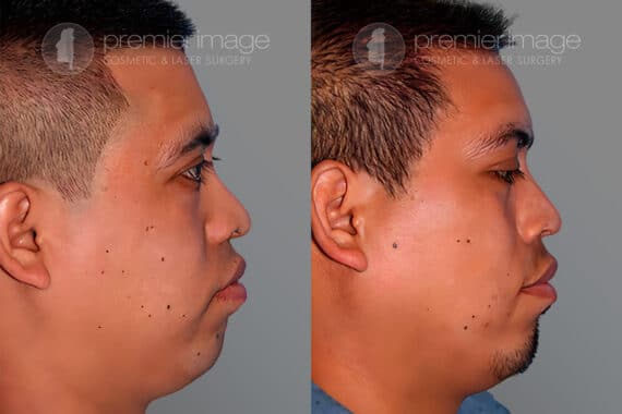 Open Rhinoplasty Before and after photos in Sandy Springs, GA, Patient 28182