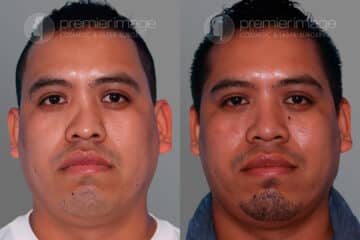 Open Rhinoplasty Before and after photos in Sandy Springs, GA, Patient 28182