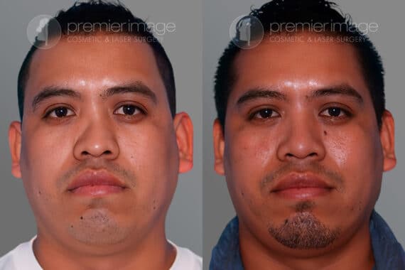 Open Rhinoplasty Before and after photos in Sandy Springs, GA, Patient 28182