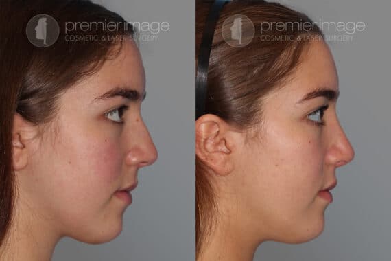 Open Rhinoplasty Before and after photos in Sandy Springs, GA, Patient 28195