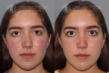 Open Rhinoplasty Before and after photos in Sandy Springs, GA, Patient 28195