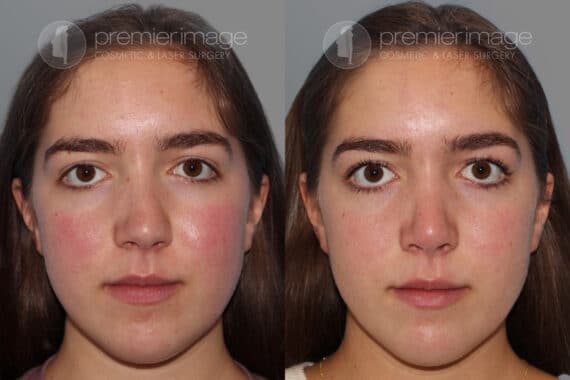 Open Rhinoplasty Before and after photos in Sandy Springs, GA, Patient 28195