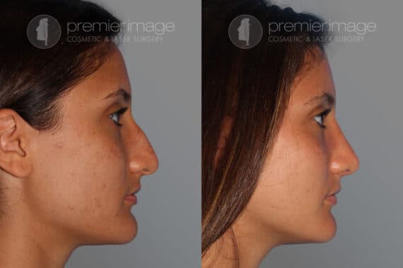 Open Rhinoplasty Before and after photos in Sandy Springs, GA, Patient 28208