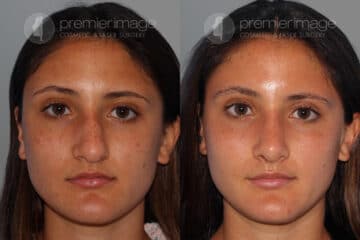Open Rhinoplasty Before and after photos in Sandy Springs, GA, Patient 28208