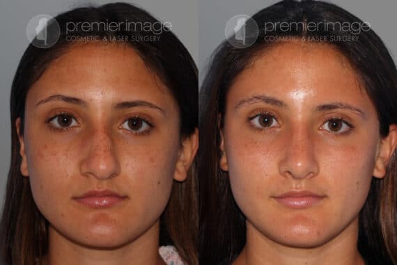 Open Rhinoplasty Before and after photos in Sandy Springs, GA, Patient 28208