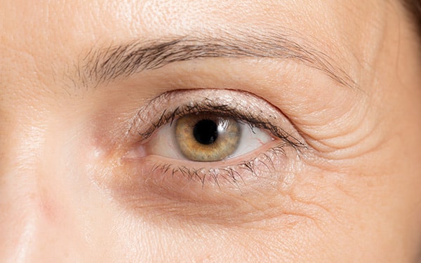 Close-up of eye with visible crow’s feet, commonly treated with Botox to reduce fine lines and wrinkles.