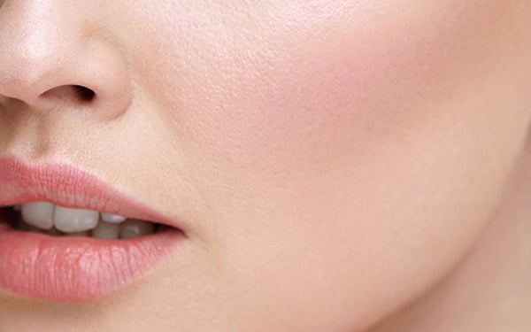 Close-up of smooth cheek and full lips, showing volume restoration and lift from Perlane and Sculptra injections.