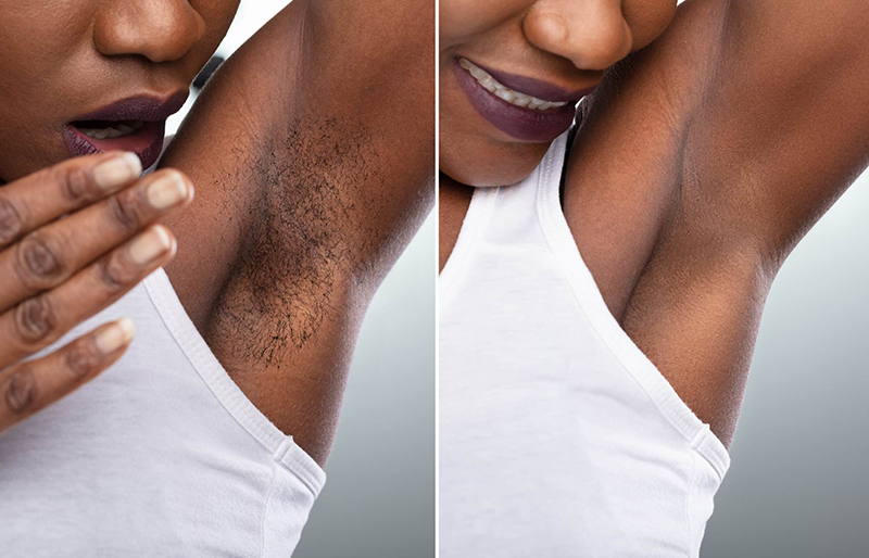Before and after results of laser hair reduction on dark underarm skin showing smooth, hair-free outcome