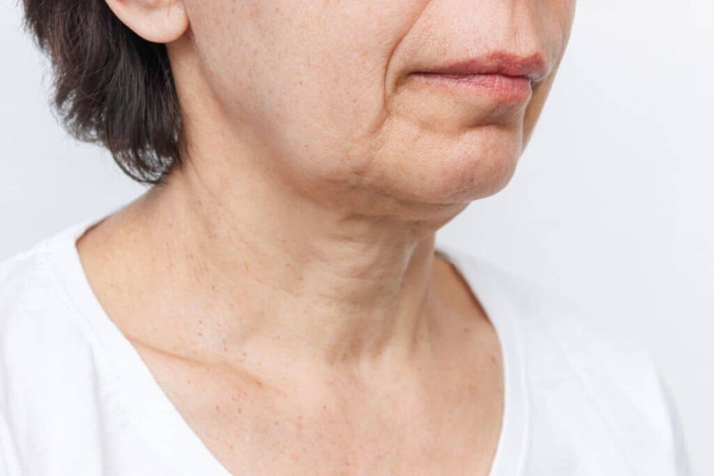 Close-up of mature woman's lower face and neck showing sagging skin and jawline laxity before treatment.