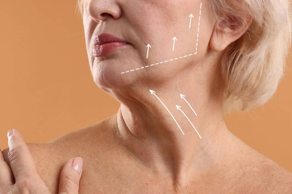 Close-up of older woman’s lower face and neck with diagram arrows showing facelift and neck lift treatment areas.