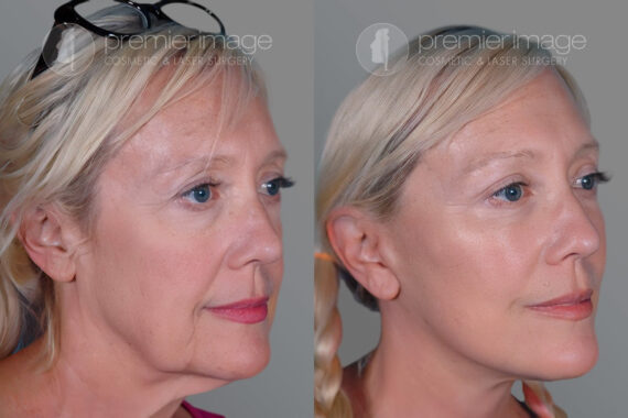 Eyelid Surgery (Blepharoplasty) Before and after photos in Sandy Springs, GA, Patient 17211