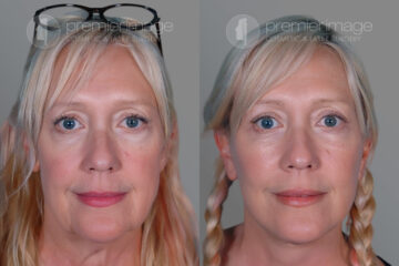 Eyelid Surgery (Blepharoplasty) Before and after photos in Sandy Springs, GA, Patient 17211