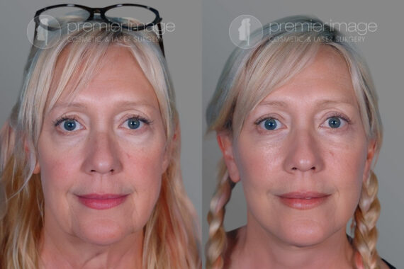 Eyelid Surgery (Blepharoplasty) Before and after photos in Sandy Springs, GA, Patient 17211