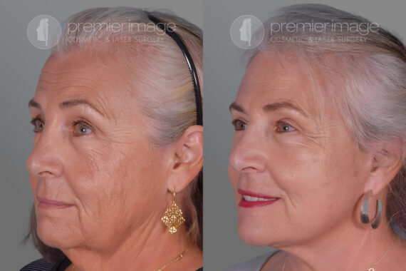 Eyelid Surgery (Blepharoplasty) Before and after photos in Sandy Springs, GA, Patient 17222