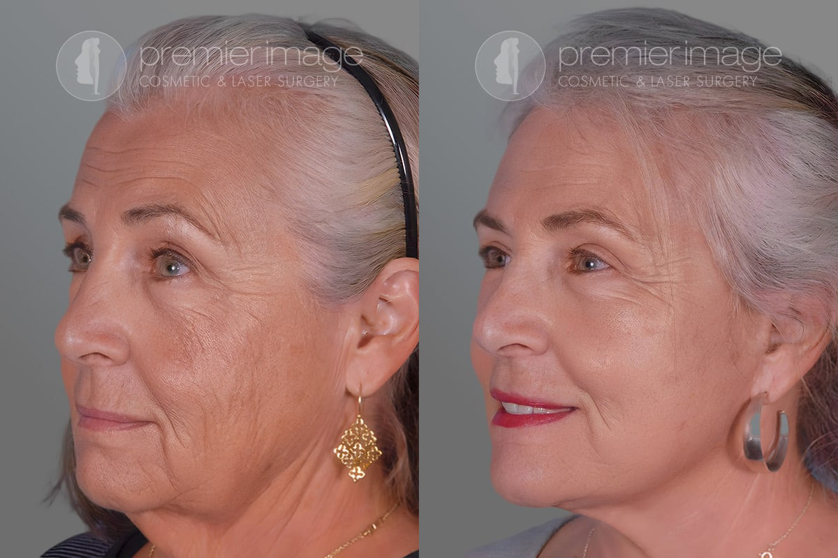 Eyelid Surgery (Blepharoplasty) Before and after photos in Sandy Springs, GA, Patient 17222