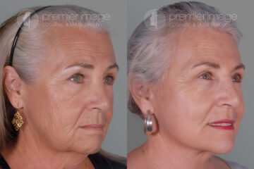 Eyelid Surgery (Blepharoplasty) Before and after photos in Sandy Springs, GA, Patient 17222