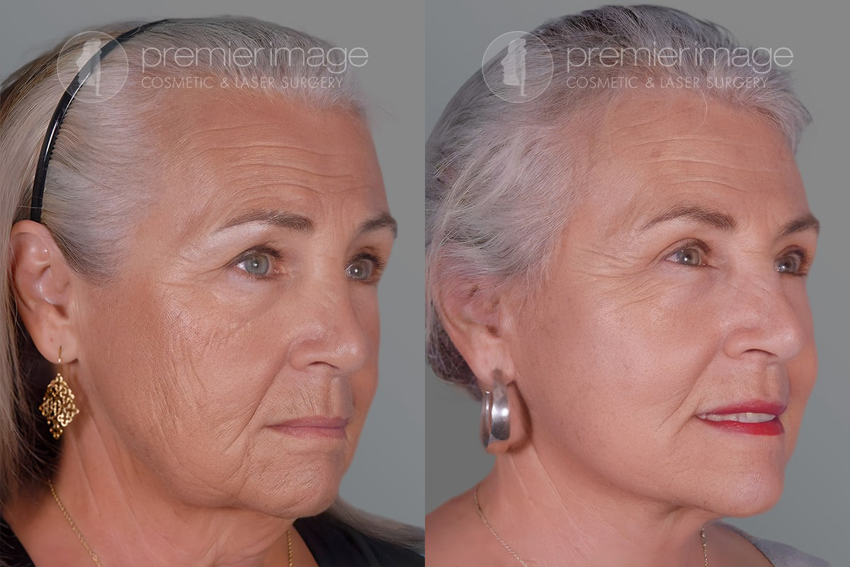 Eyelid Surgery (Blepharoplasty) Before and after photos in Sandy Springs, GA, Patient 17222