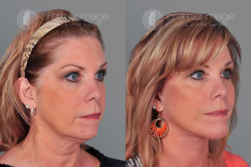 Chin Augmentation Before and after photos in Sandy Springs, GA, Patient 15750