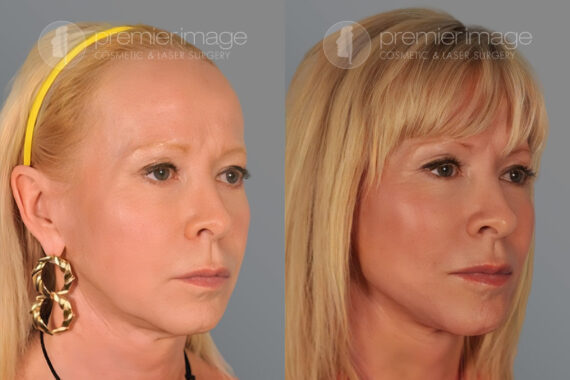 Facelift and Necklift Before and after photos in Sandy Springs, GA, Patient 16180