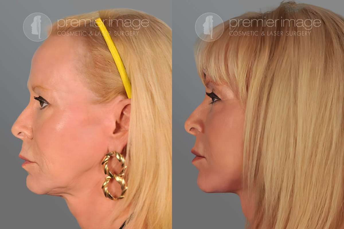 Facelift and Necklift Before and after photos in Sandy Springs, GA, Patient 16180