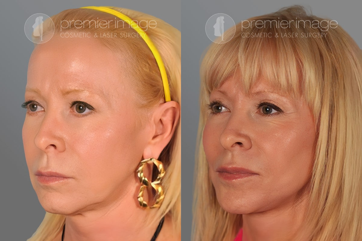 Facelift and Necklift Before and after photos in Sandy Springs, GA, Patient 16180