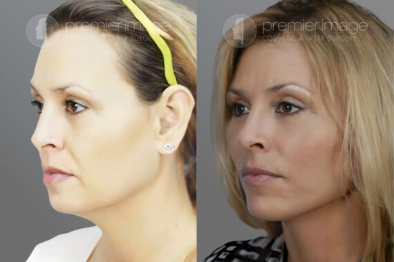 Facelift and Necklift Before and after photos in Sandy Springs, GA, Patient 16089