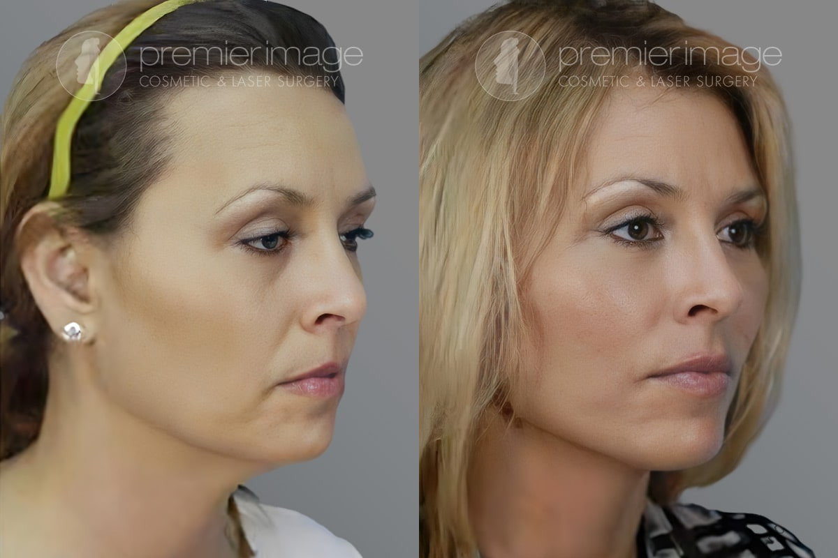 Facelift and Necklift Before and after photos in Sandy Springs, GA, Patient 16089