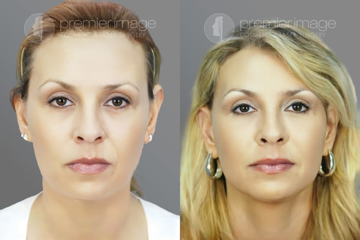 Facelift and Necklift Before and after photos in Sandy Springs, GA, Patient 16089