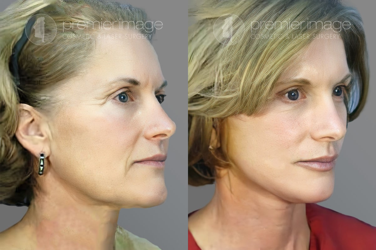 Facelift and Necklift Before and after photos in Sandy Springs, GA, Patient 16096