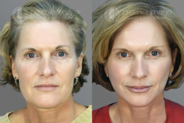 Facelift and Necklift Before and after photos in Sandy Springs, GA, Patient 16096