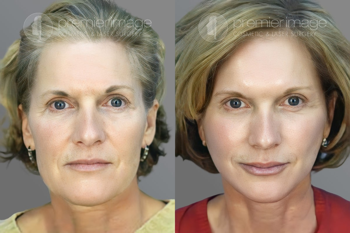 Facelift and Necklift Before and after photos in Sandy Springs, GA, Patient 16096