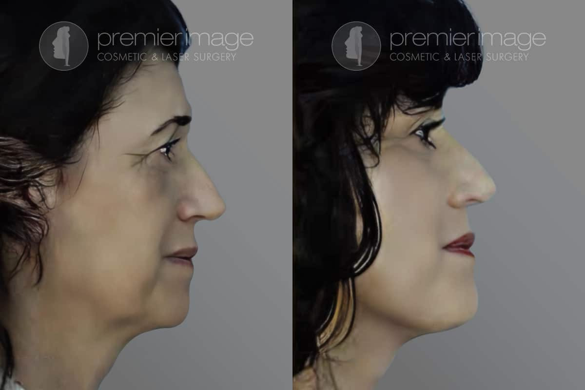 Facelift and Necklift Before and after photos in Sandy Springs, GA, Patient 16099