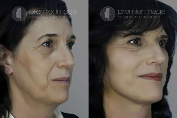 Facelift and Necklift Before and after photos in Sandy Springs, GA, Patient 16099