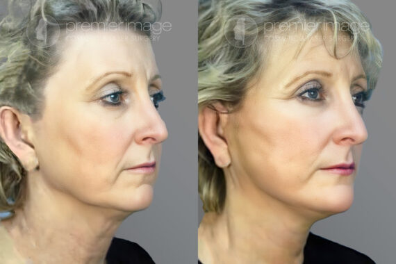 Facelift and Necklift Before and after photos in Sandy Springs, GA, Patient 16104