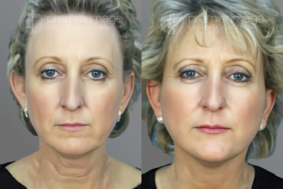 Facelift and Necklift Before and after photos in Sandy Springs, GA, Patient 16104