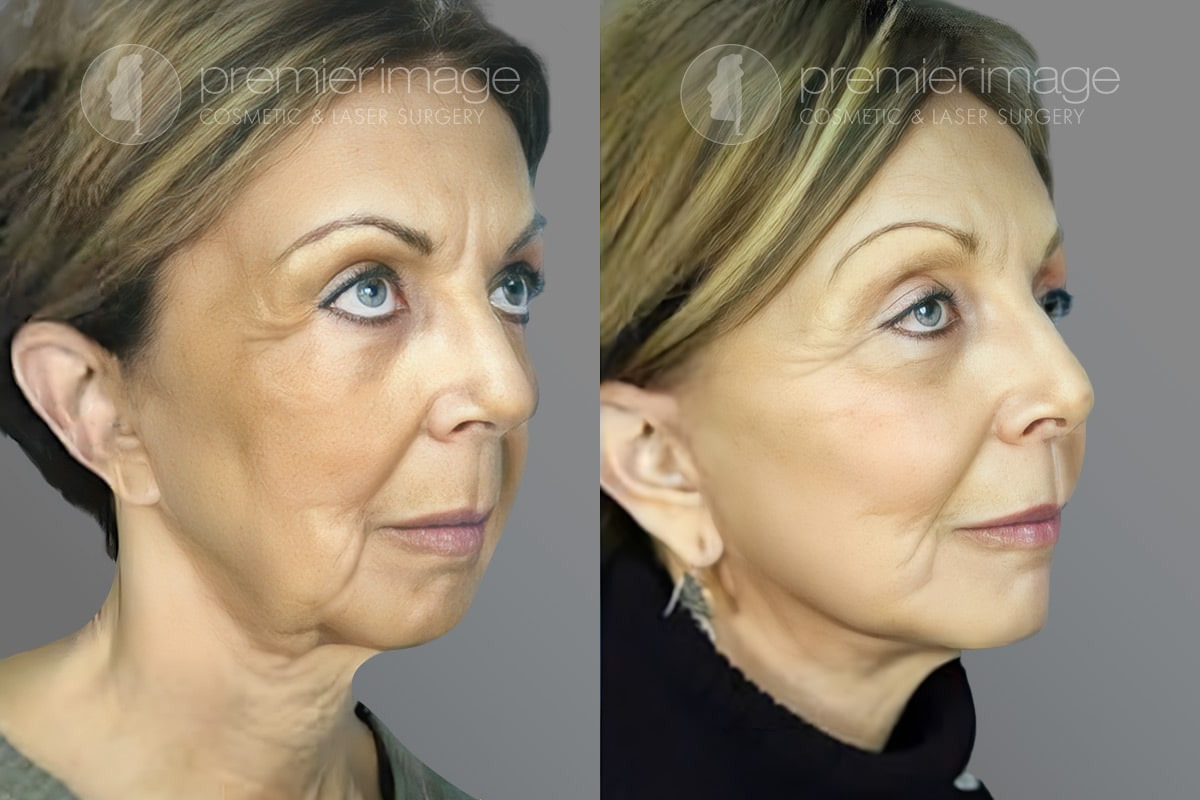 Facelift and Necklift Before and after photos in Sandy Springs, GA, Patient 16111